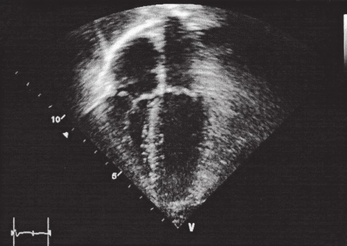 Příklad echokardiografického zobrazení srdce.