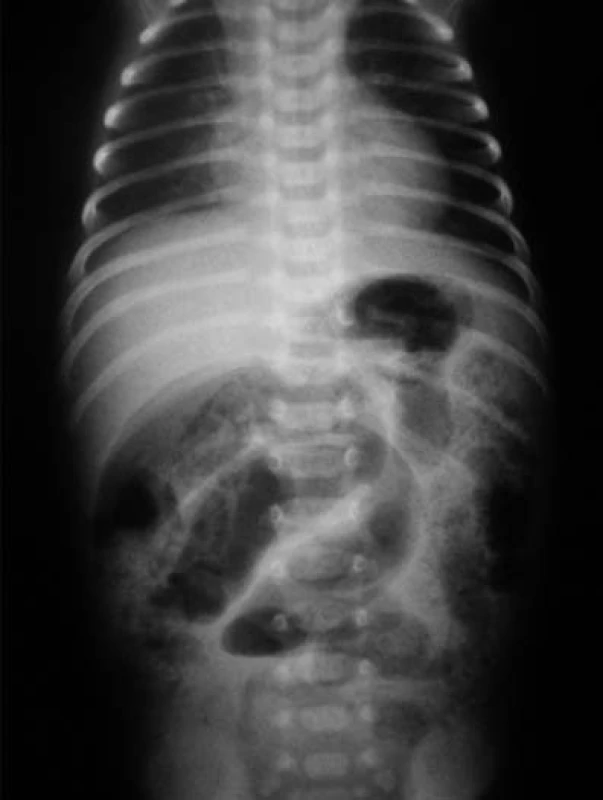 Pneumatóza čreva – drobné „bublinkové“ prejasnenia v črevnej stene. Obraz patognomický pre NEC.
Fig. 1. Pneumatosis of intestine – minute “bubble” clearing in the intestinal wall: The picture is pathognomic for NEC.