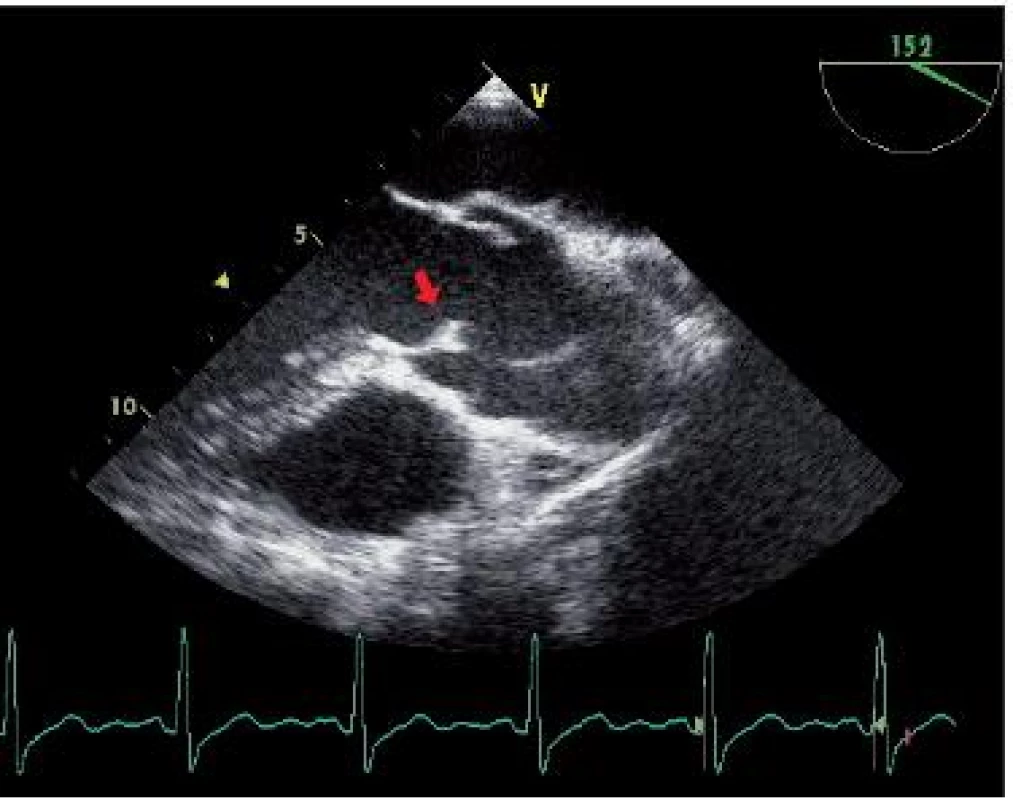 Transezofageální ultra zvukové vyšetření srdce v dlouhé ose v systole. Je patrné vydouvání (doming) „předního“ cípu bikuspidální aortální chlopně s raphe (šipka), přestože je chlopeň prosta stenózy nebo insufi cience.