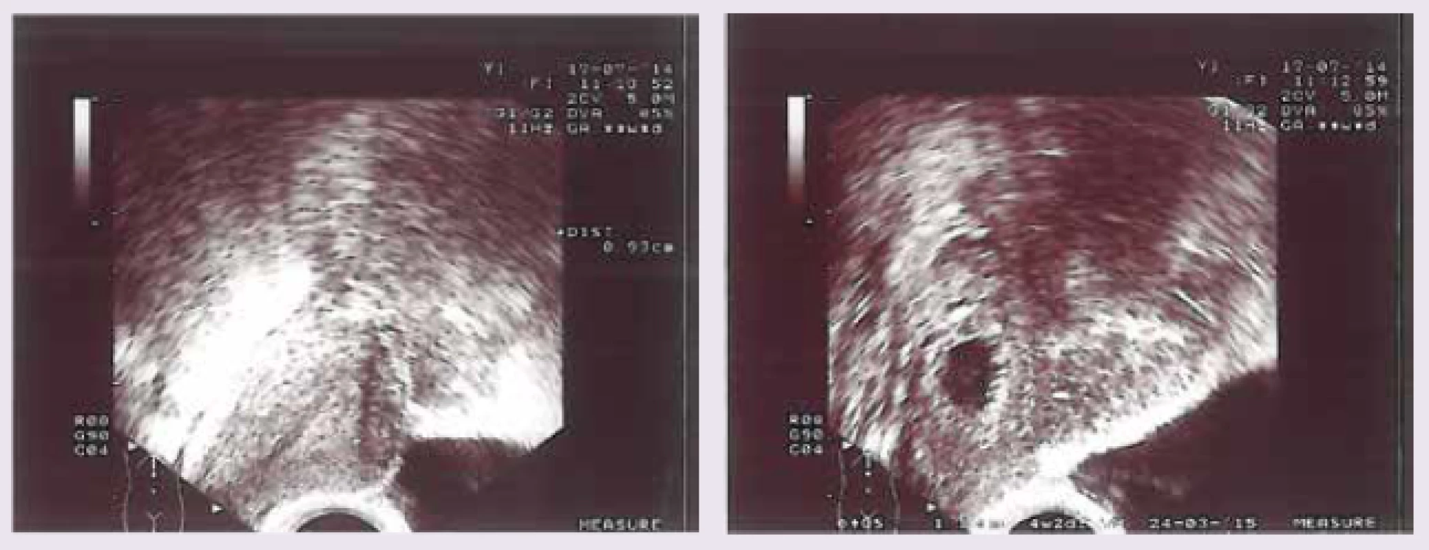 Pohled na pravý roh děložní s gestačním váčkem velikosti 11 mm odpovídající gestačnímu týdnu 4 + 1