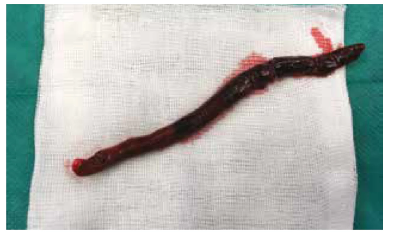 Embolus odstraněný z pravé a. subclavia<br>
Fig. 2: Embolus extracted from the right subclavian artery
