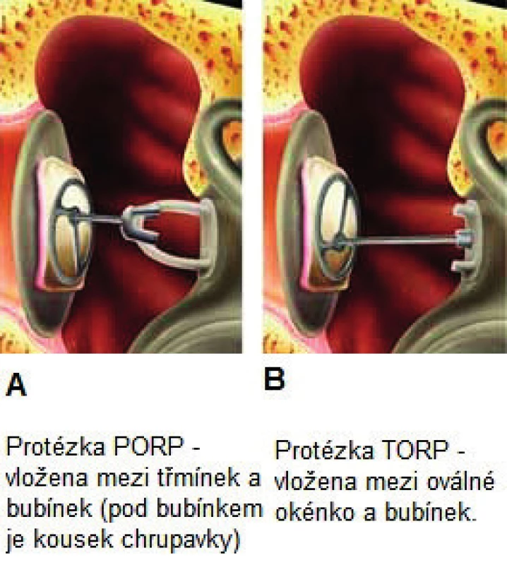 A, B. Rekonstrukce převodního systému středního ucha pomocí titanových protéz.
Fig. 9. A, B. Reconstruction of the middle ear ossicles, titanium prosthesis.