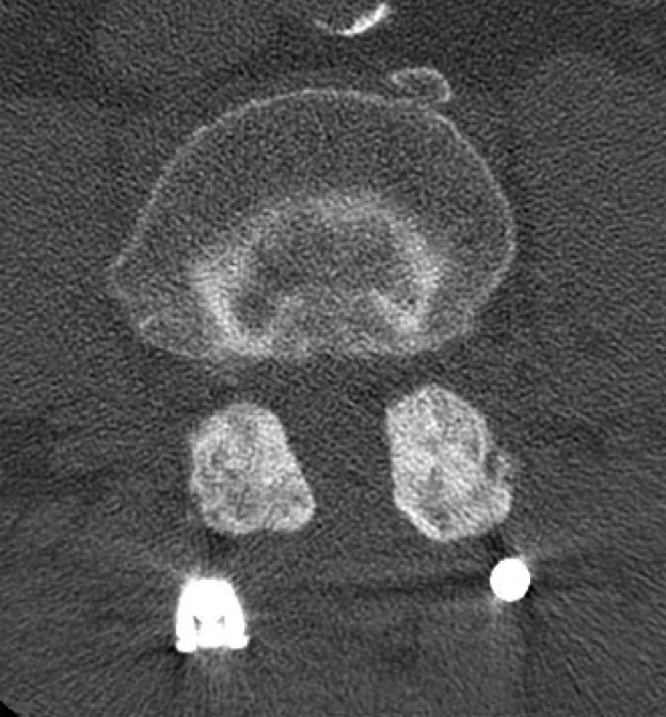 CT LS páteře, axiální sken v kostním okně, jeden rok po operaci Průkaz oboustranné nitrokloubní artrodézy v segmentu L4/5. Rozsah nitrokloubní fúze je na každém kloubu vždy 100 %). Muž, 68 let, operační indikace: degenerativní spondylolistéza L4 gr. I (translace dle dynamických skiagramů 5–7 mm), stenosis L4/5. 
Fig. 3: CT scan, the bone window, one year after surgery. Bilateral intraarticular solid bone arthrodesis at level L4/5. The extent of the fusion is 100 % in both joints. Male, 68 years old, surgical indication: degenerative spondylolisthesis L4 gr. I (translation in dynamic skiagrams 5–7 mm), stenosis L4/5.