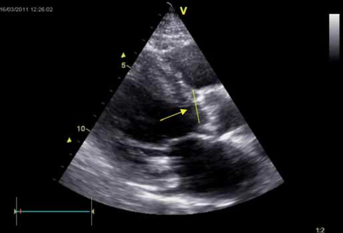 Stenóza aorty degenerativní – parasternální dlouhá osa levé komory. Patrné je ztluštění aortálních cípů s kalcifikacemi, hypertrofie myokardu (septum 20 mm), šipkou je označeno místo měření rozměru LVOT, jednoho z parametrů sloužících k výpočtu AVA podle rovnice kontinuity.