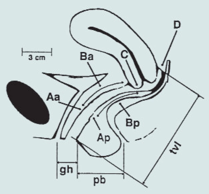 Kvantifikace POP – systém šesti bodů, genitální hiátus (gh), perinální oblast (pb) a celková délka vaginy (tvl).