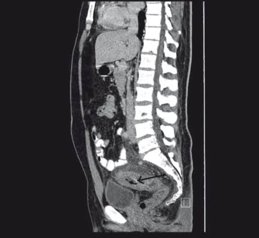 Stenóza střeva s prosáknutím stěny při CT zobrazení.
Fig. 3. Stenosis of the bowel with infiltration on the CT scan.