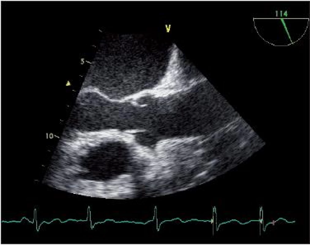 Transezofageální ultra zvukové vyšetření srdce v dlouhé ose v systole. Jsou patrné jemné cípy trikuspidální aortální chlopně, jejich separace dosahuje diametru aortálního anulu.
