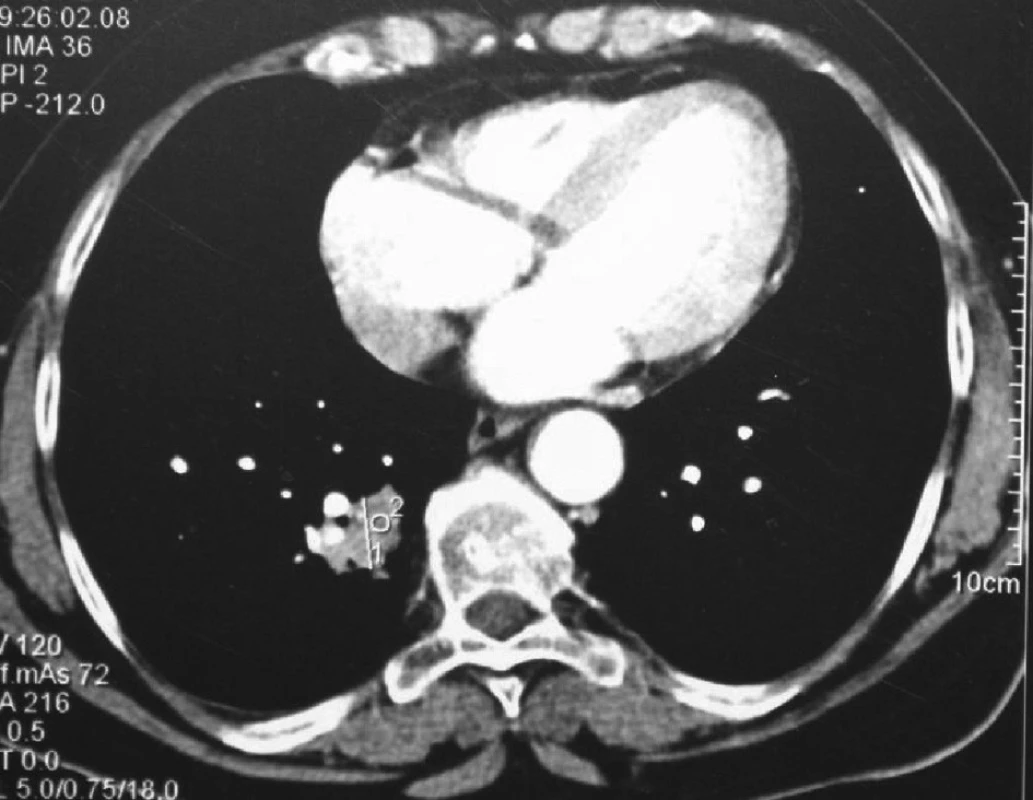 CT plic před provedením RFA – tumor v dolním laloku pravé plíce
Fig. 3: Lung CT before RFA – tumour in the lower lobe of the right lung