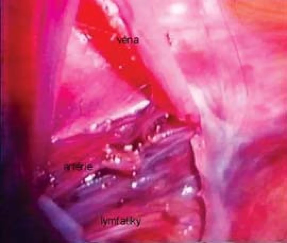Pohled na svazek vnitřních spermatických cév a doprovodných lymfatik při laparoskopické mikrochirurgické lymfatika šetřící operaci varikokély.