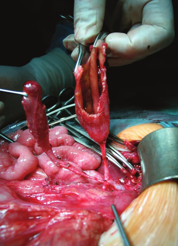 Otvorený lúmen multicysty vpravo, vľavo žlčník
s vlastným ústím do choledochu
Fig. 3. Multicyst with opened lumen on the right side, on the
left is gall-bladder with own choledochal junction