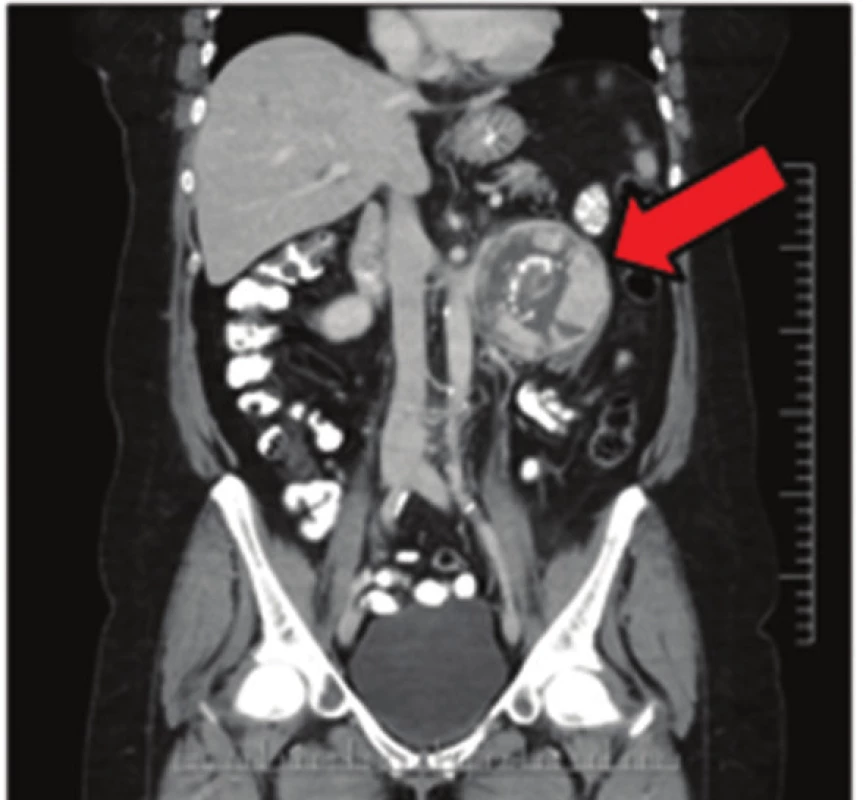 Extraadrenální paragangliom na CT snímku
Fig. 3: Extraadrenal paraganglioma on CT scan