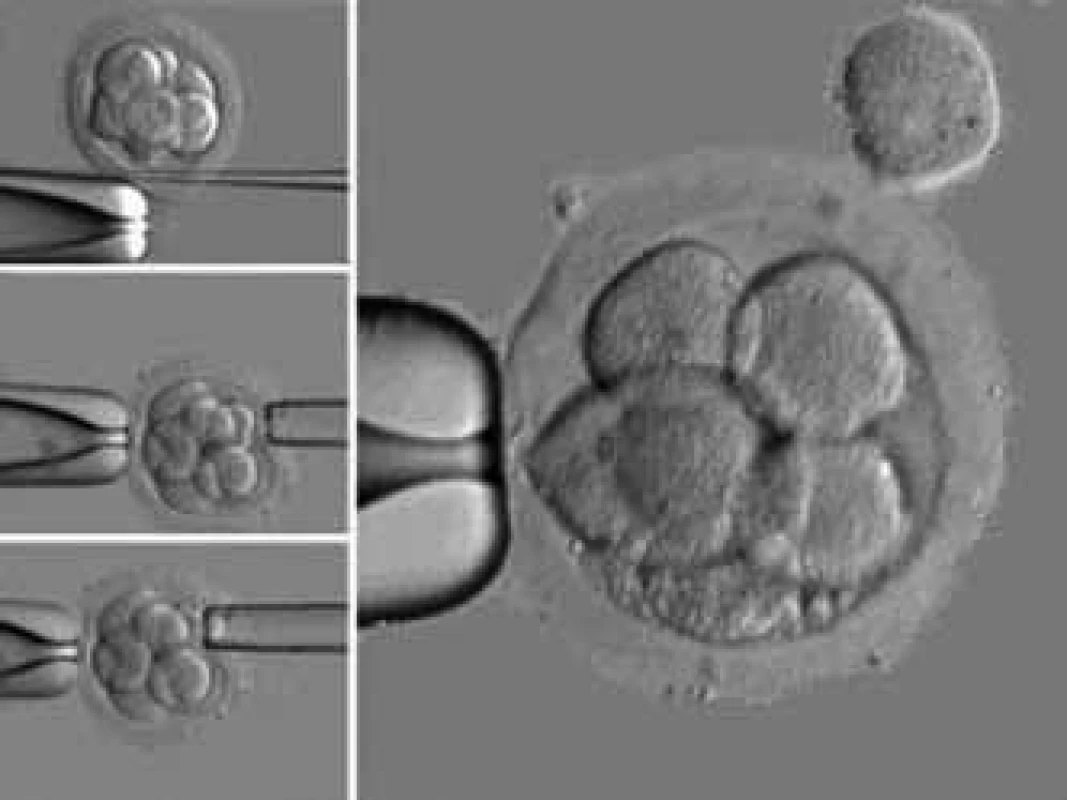 Odběr buněk při preimplantačním genetickém vyšetření embryí.