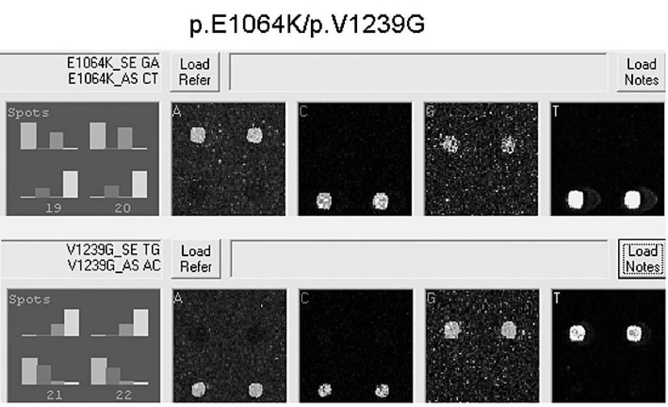 Výstup z programu Genorama: Výsledek čipové analýzy – pacient 9 s genotypem p.E1064K/p.V1239G