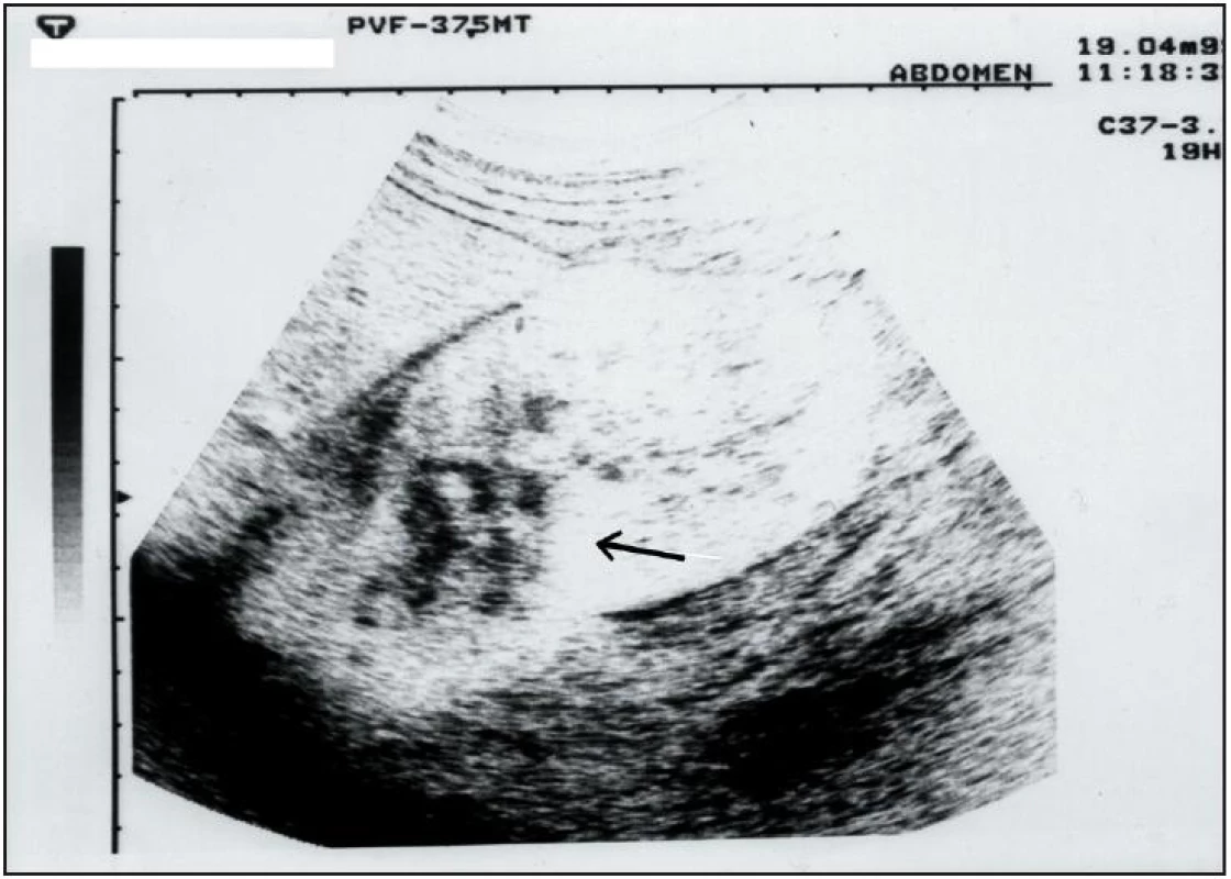 Ultrazvukové vyšetření ledvin. Je patrný exofyticky rostoucí útvar v dolní části pravé ledviny se zvýšenou echogenitou velikosti cca 5x6 cm (šipka).