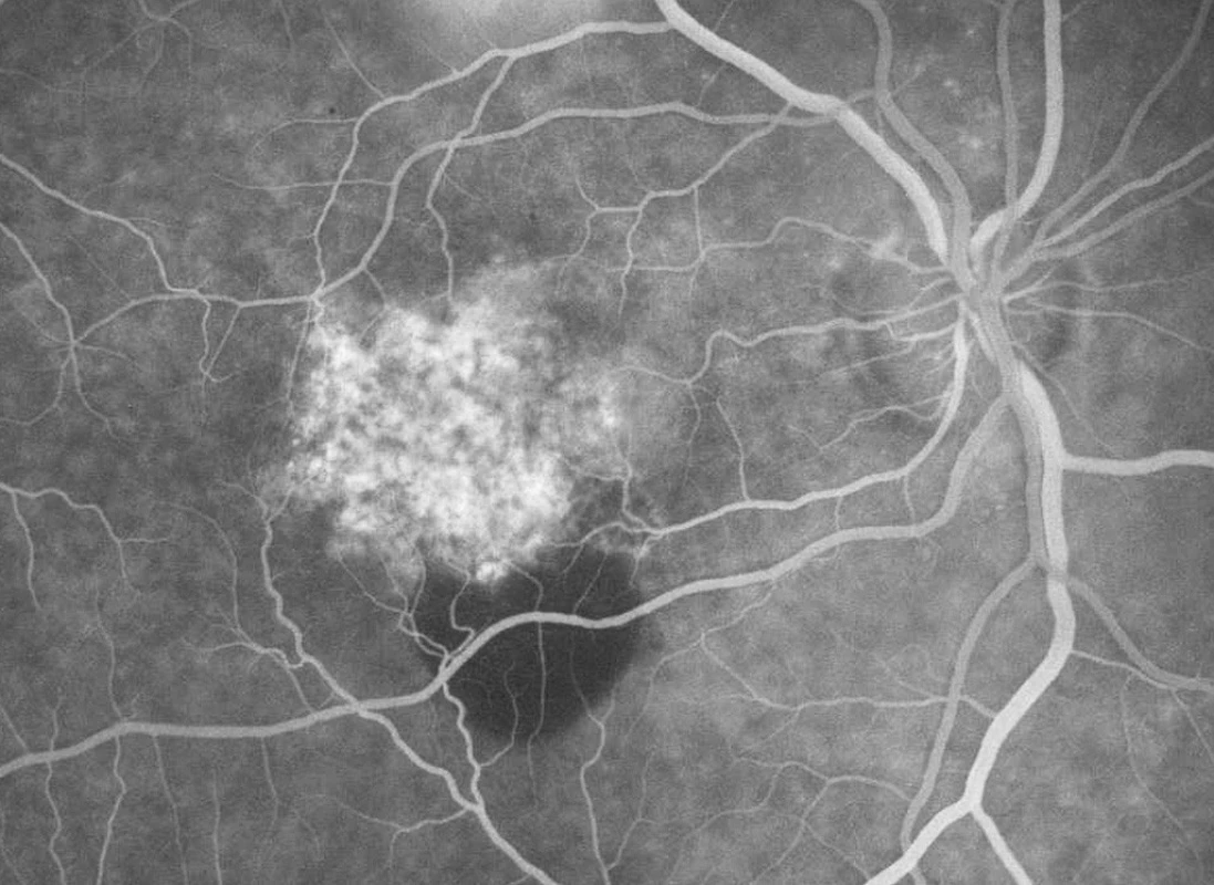 Fluorescenční angiografie pravého oka pacienta před FTV/RIV