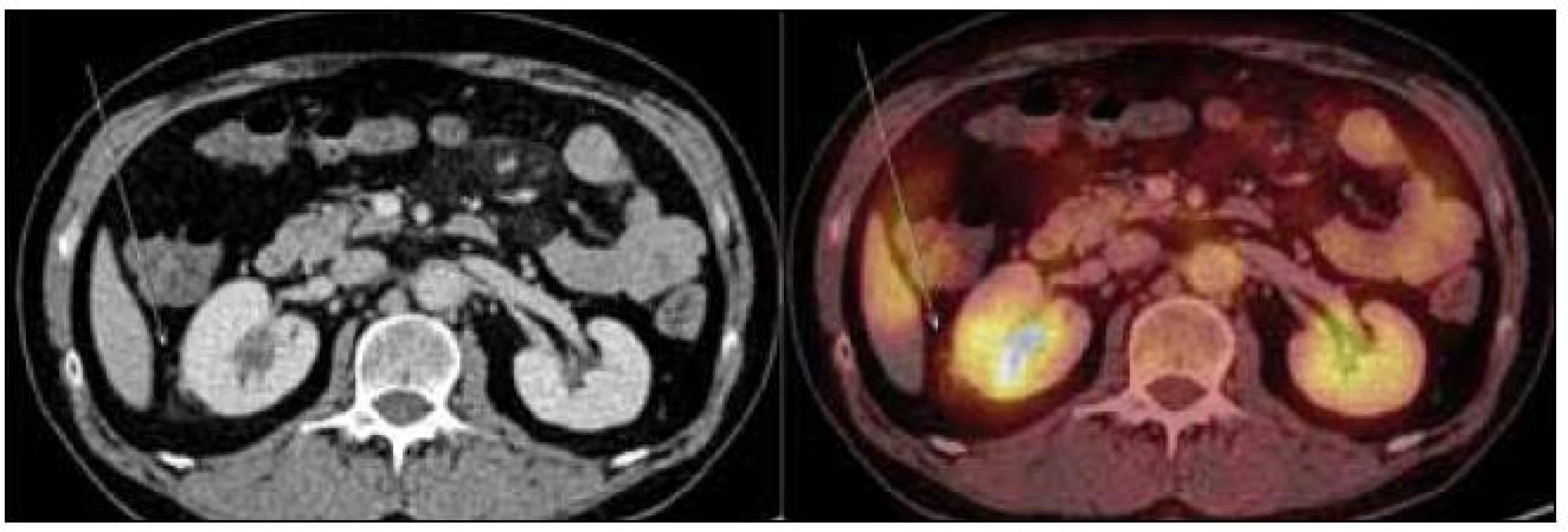 PET-CT zobrazení břicha. Zvýšení denzity perirenálního tuku, zneostření kontury pravé ledviny – diskrétní známky vznikajících fibrózních změn (označeno šipkou). Aktivní moč v dutém systému ledvin, perirenálně evidentní hypermetabolizmus glukózy nedetekujeme.