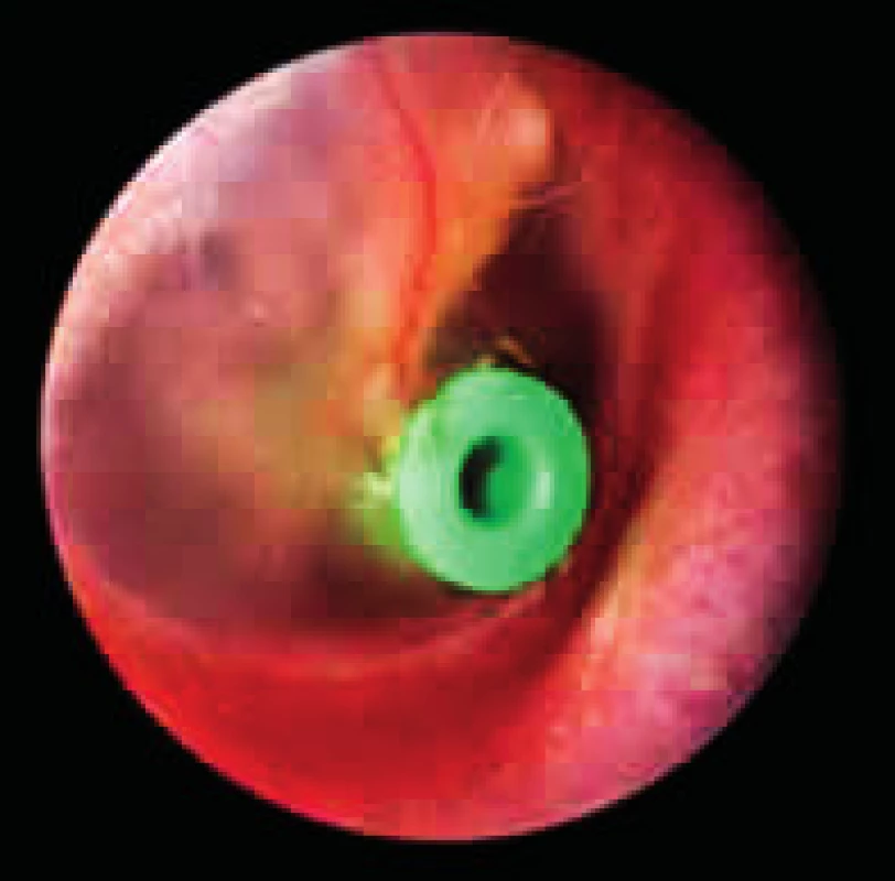 Tlak vyrovnávající trubička v ušním bubínku.
Fig. 4. Ventilation tube in the tympanic membrane.