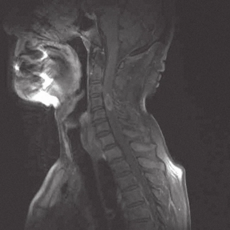 MRI krční páteře v sagitální rovině, v T1 módu s kontrastem, před operací, na úrovni C4 intramedulární metastáza velikosti 24 × 12 mm, sytící se postkontrastně.