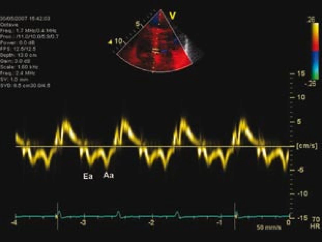Tkáňová dopplerovská echokardiografie septálního mitrálního anulu, prokazující zřetelně nízkou časně diastolickou relaxační rychlost pohybu anulu, která v kombinaci s hodnocením transmitrálního průtoku (obr. 1) ukazuje na zvýšení plnicího tlaku levé komory při její diastolické dysfunkci. 
