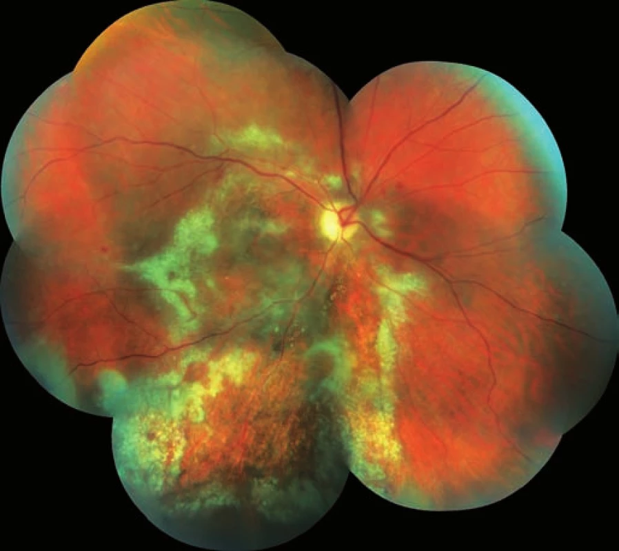 Pravé oko. Akutní stadium CMV-retinitidy, žlutobílé okrsky retinální nekrózy.