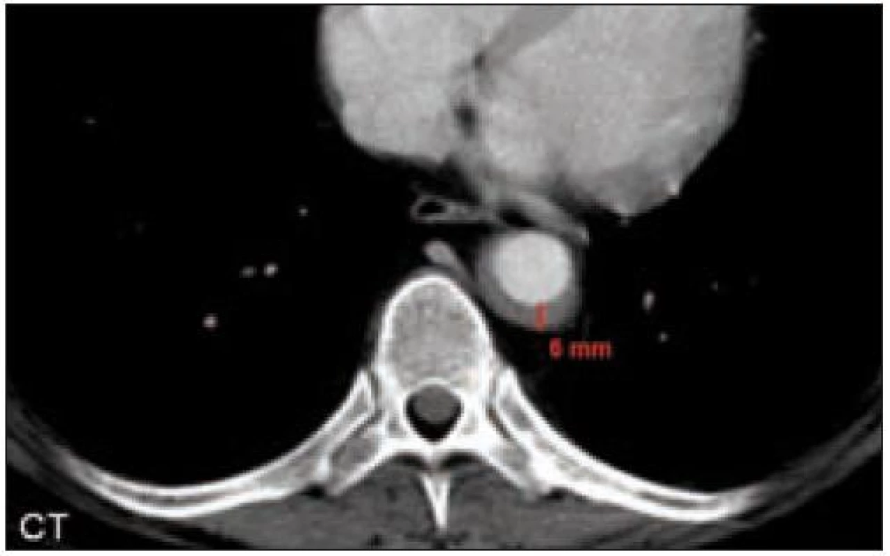 CT hrudníku. Dorzální stěna sestupné aorty je zesílena nepravidelně až na 6 mm.
