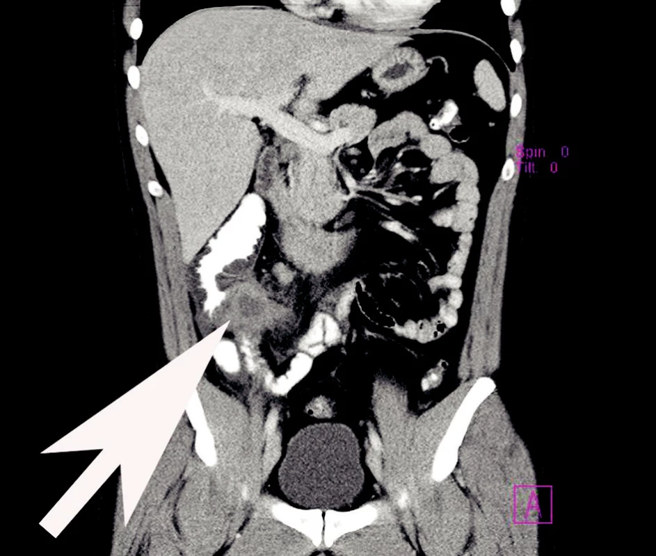 Zánětlivý infiltrát paracékálně po apendektomii
Fig. 4. Inflammatory paracecal infiltration following appendectomy