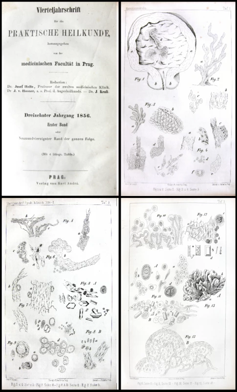 Ilustrace cytologických nálezů z nátěrů moči při karcinomu močového měchýře z Lamblovy originální publikace.