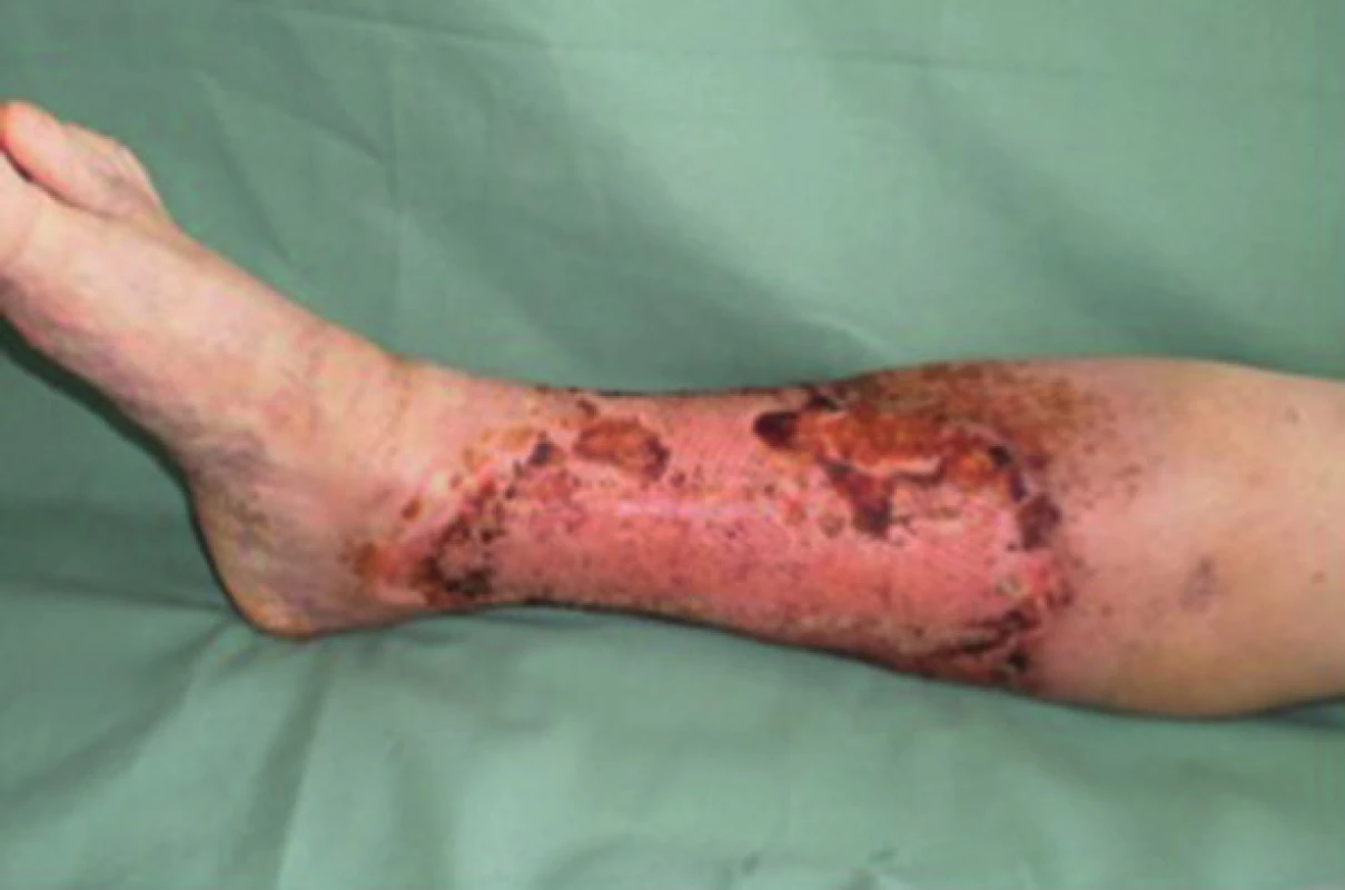 Pacient č. 3 − 15. den po operaci s použitím PRP – kompletně zhojeno
Fig. 3: Patient No. 3 − 15 days after surgery with PRP – wound completely healed