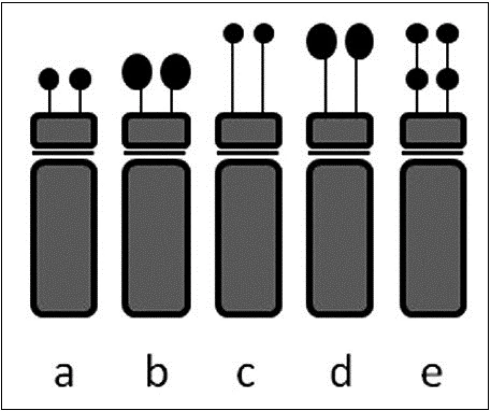 Variabilita útvarů na krátkém ramenu akrocentrického chromozomu (vybrané příklady): 
a) norma; b) ps+ (zvětšené satelity); c) pstk+ (prodloužené stopky); d) pstk+ps+ (zvětšené satelity na prodloužených stopkách); e) pss (dvojité satelity)