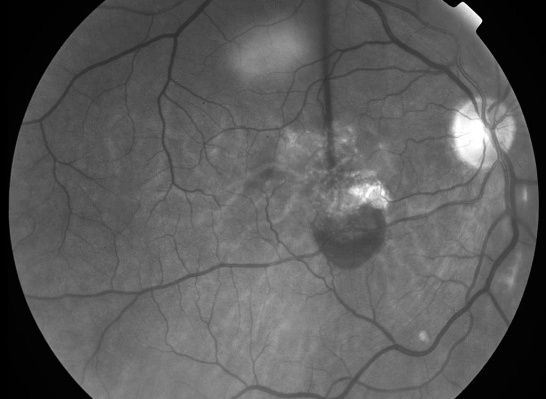 Bezčervený snímek fundu pravého oka pacienta před FTV/RIV