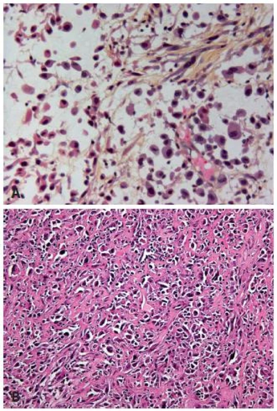 A: Poorly differentiated UC with plasmocytoid features, the cells are discohesive, stroma is poor. B: Poorly differentiated UC with rhabdoid features. Pseudosarcomatous stroma in between the tumor cells.