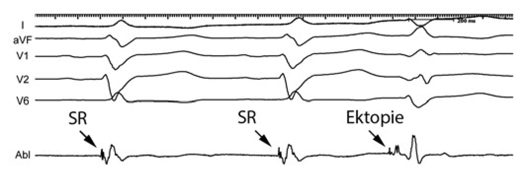 Záznamy z povrchového EKG (I, aVF, V1, V2, V6) a distálního bipólu mapovacího katétru (Abl d)