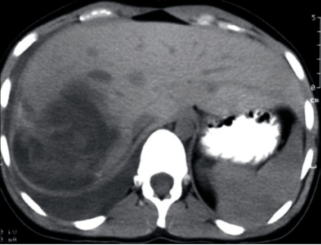CT snímek břicha s poraněním jater IV. stupně indikované k laparotomii s perihepatickým packingem