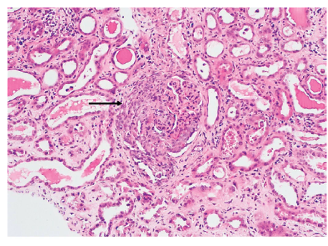 Granulomatóza s polyangiitidou. V centru je patrný glomerulus s nekrózou postihující více než 50 % kapilárních kliček a velkým celulárním srpkem (šipka). Okolní tubuly jsou oploštělé, se známkami ischemie (akutní tubulární nekróza). Barvení HE, zvětšení 200x.
