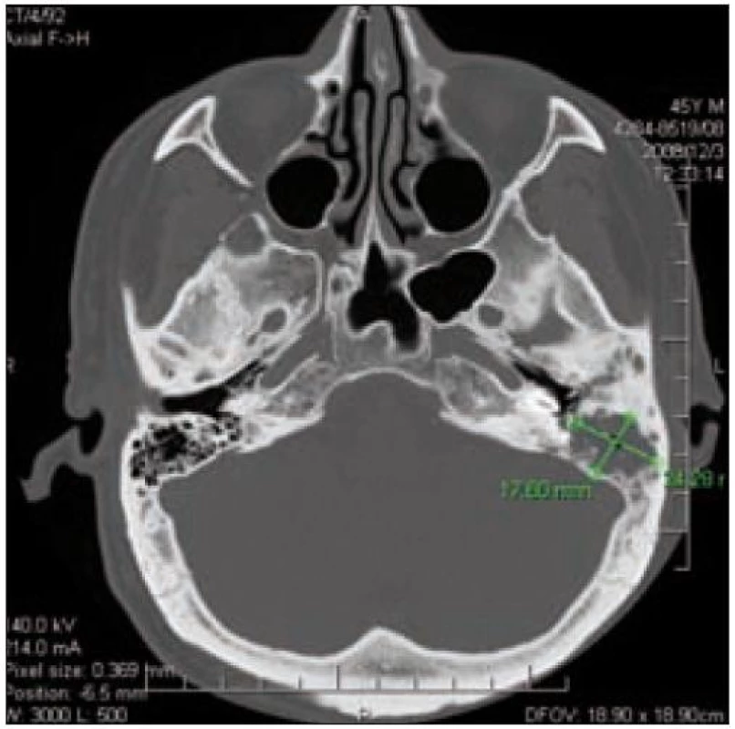 CT lebeční spodiny – obraz destrukce levé pyramidy u pacienta 2.