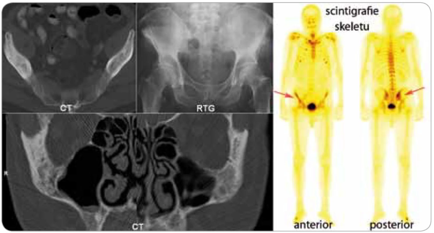 Na CT vyšetření se zobrazila smíšená osteolyticko-osteosklerotická ložiska jednak v oblasti lícní kosti (na obrázku dole), ale především v pravé lopatě kosti kyčelní, kde prokázala klasická kostní scintigrafie pomocí technecium pyrofosfátu zvýšenou akumulaci radiofarmaka. Na celotělovém scintigramu skeletu je patrná abnormální akumulace radiofarmaka i v oblasti sakroiliakálního kloubu vpravo. Hodnota T-skóre kostní minerální denzity v oblasti L2-4 měřené metodou DEXA byla v roce 1999 -0,3 SD, v roce 2005 se osteopenie v této oblasti prohloubila na -1,4 SD.