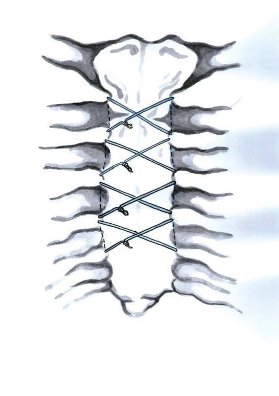 Perikostální drátěné osmičky (Kresba archiv autora)
Fig. 6: Figure-eight pericostal wire closure