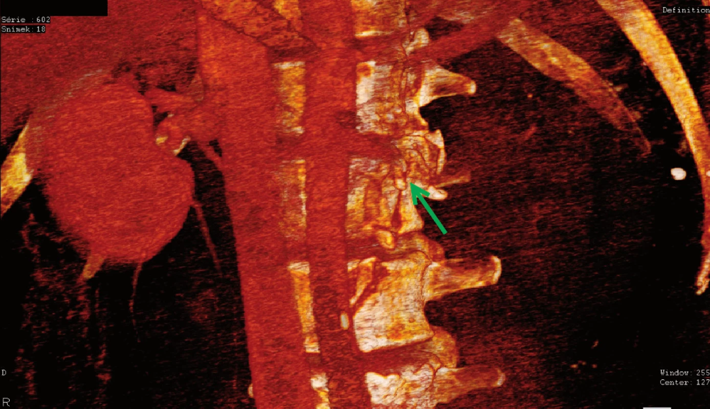 Traumatický uzávěr renální tepny vlevo, řešeno nefrektomií
Fig. 3. Traumatic occlusion of the left renal artery, treated by nephrectomy on the left side
