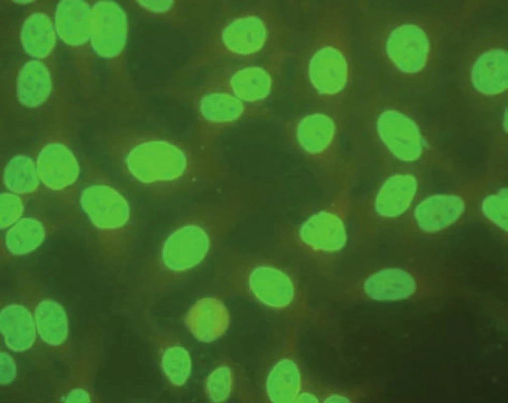 Imunoflourescenční obraz antinukleárních protilátek – homogenní typ (substrát – buněčná linie Hep-2).
Fig. 3. Immunofluorescent image of antinuclear antibodies – homogenous type (substrate – Hep-2 cell line).