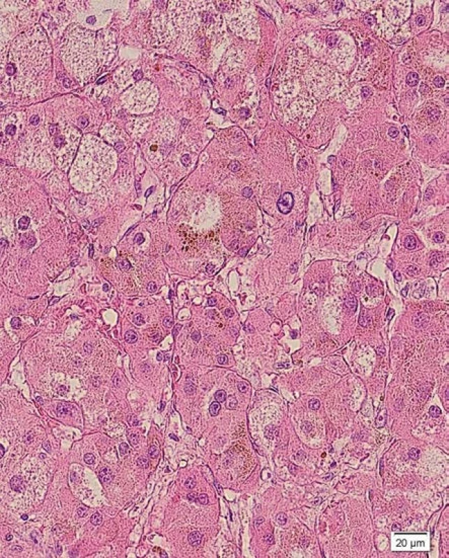 Mikroskopicky se adenom skládá ze směsi buněk eozinofilních a buněk s pěnitou cytoplazmou bohatou na lipidy, které připomínají buňky zona fasciculata. Četné nádorové buňky v cytoplazmě obsahují granula lipofuscinu (HE, 400×)
Fig. 5. The adenoma is composed of cells with eosinophilic cytoplasm as well as of cells similar to those of the normal fasciculata layer. Numerous neoplastic cells contain cytoplasmic granules of lipofuscin (H&amp;E, 400×)