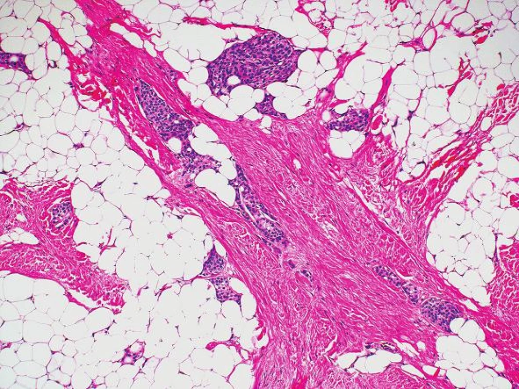 Ostrůvky meningoteliálních buněk uložených ve zralé pojivové tkáni