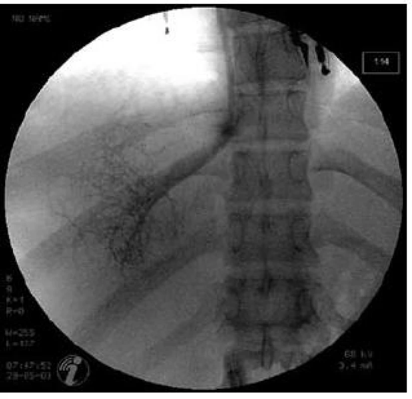 Katetrizace jaterních žil u pacienta s Budd-Chiariho syndromem.
Fig. 5. Hepatic vein catheterization in a patient with Budd-Chiari syndrome.