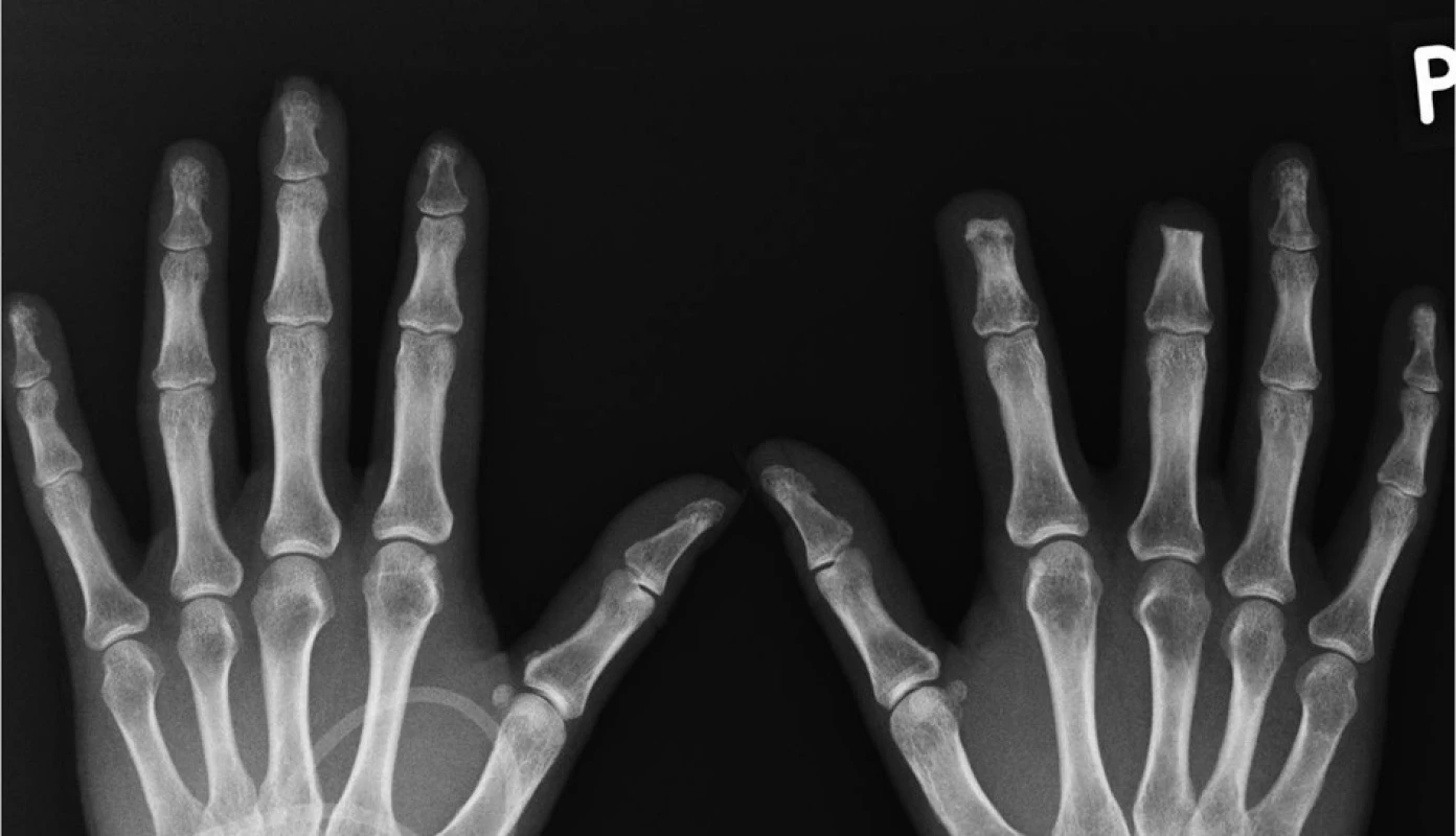 RTG snímek rukou.
(prosinec 2010, autor snímku: prim. MUDr. J. Gatterová, Revmatologický ústav Praha) Redukce měkkých tkání konečků 2. a 3. prstu levé ruky. Resorpce skeletu distálního článku 2.,3. a 5. prstu levé ruky (lytické změny tuberositas unguicularis distálního článku prstu levé ruky, počínající destrukce distálního článku 5. prstu levé ruky) Stav po chirurgické amputaci distálního článku 2. a 3. prstu pravé ruky