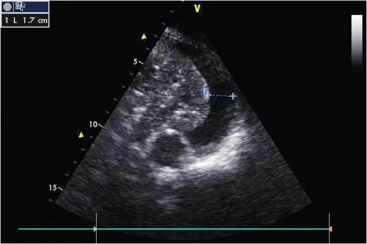 Levostranný hrudní výpotek o objemu cca 340 ml
Přes výpotek je patrna atelektáza levého dolního laloku, která společně s tekutinou umožňuje vidět sestupnou aortu.