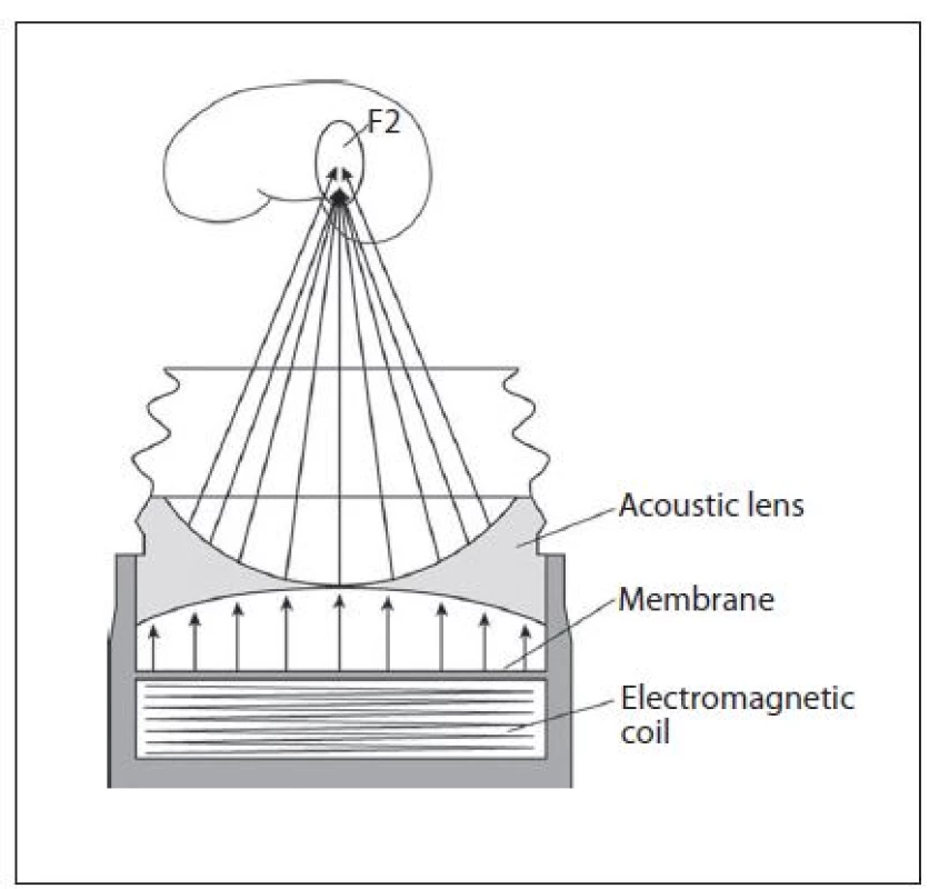 Princip vzniku a usměrnění výboje akustickou čočkou u magnetického generátoru
Fig. 7. Principle and spark aiming by acoustic lens of a magnetic generator