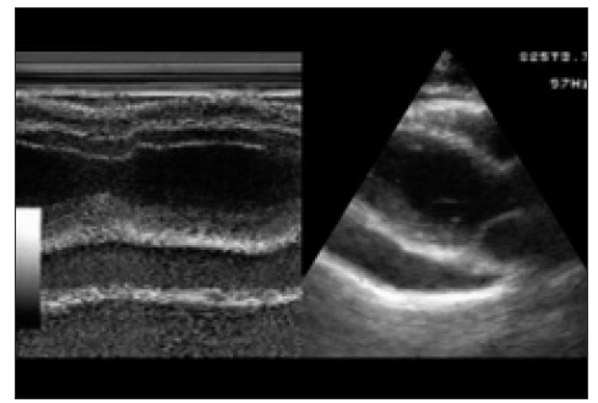Echokardiografický nález u pacientky 1 před fenestrací perikardu, výpotek za zadní stěnou levé komory a před pravou komorou. Paresternální dlouhá osa, 1- a 2rozměrné zobrazení.