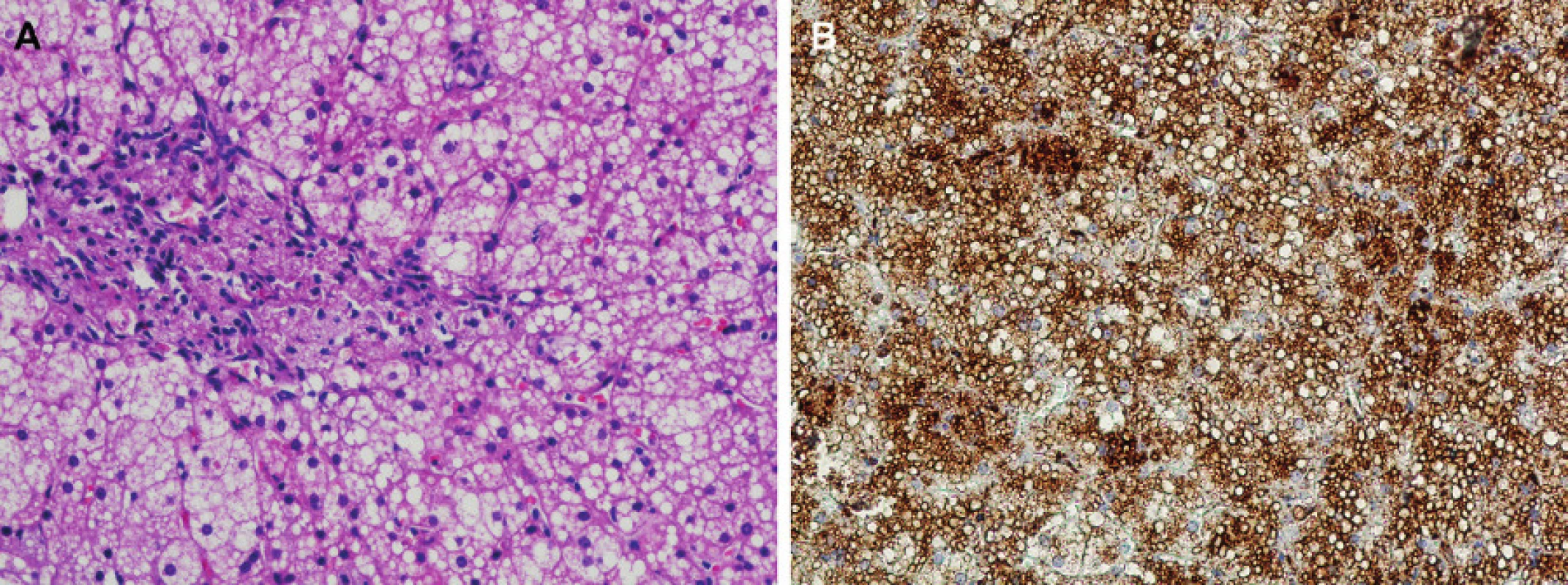 Typický nález jaterní biopsie u 2leté dívky s diagnózou CESD.
(A) Mikrovezikulární uniformní steatóza hepatocytů. Masivní infiltrace portálního pole střádajícími makrofágy a portální fibróza. Barvení HE, zvětšení 20x.
(B) Imunohistochemická detekce lysosomálního markeru LAMP2 demonstrující výraznou expanzi lysosomálního systému hepatocytů a intralysosomální lokalizaci střádaných kapének neutrálních lipidů. Zvětšení 20x.
Fig. 1. Fig. 1. Typical finding of liver biopsy in a 2-year girl with CESD diagnosis.
(A) Microvesicular uniform steatosis of hypatocytes. Massive infiltration of the portal field by storing macrophages and signs of portal fibrosis are apparent. HE staining, objective 20-fold.
(B) Immunohistochemical detection of lysosomal marker LAMP2 demonstrating a marked expansion of the hepatocyte lysosomal system and intralysosomal localization of the stored droplets of neutral lipids. Objective 20-fold.
