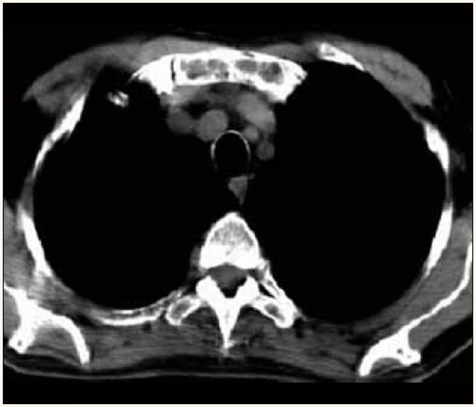Osteolytická ložiska manubria sterna v CT obraze.