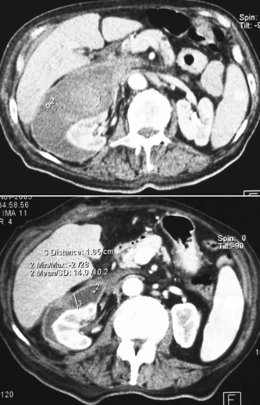 a, b. Pacient č. 1. CT obraz retroperitoneálneho hematómu medzi pravou obličkou a pravým lalokom pečene
Pic. 2a, b. Patient Nr. 1: A CT scan revealing a retroperitoneal hematoma between the right kidney and the right liver lobe