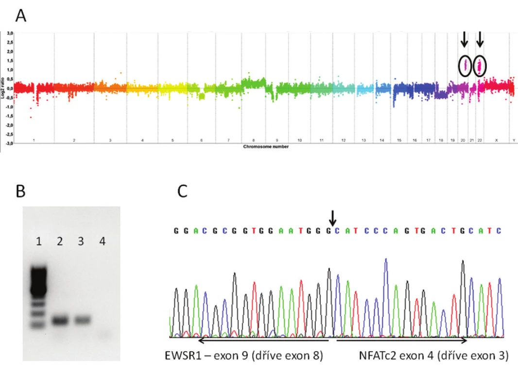 A. Array CGH s vyznačenými oblastmi zisků (gains) na chromosomech 20 a 22. Gain na chromosomu 20 zasahuje část genu NFATc2, gain na chromosomu 22 část genu EWSR1. B. Agarová elektroforéza s produkty RT-PCR k průkazu fúzního genu EWSR1-NFATc2 (1 - marker; 2 - fúzní transkript EWSR1-NFATc2 pacienta 1; 3 - fúzní transkript EWSR- 1-NFATc2 pacienta 2; 4 - „non-templátová“ kontrola). C. Sekvence fúzního transkriptu EWSR1-NFATc2. Fúze mezi exonem 9 (dříve 8) genu EWSR1 a exonem 4 (dříve 3) genu NFATc2.